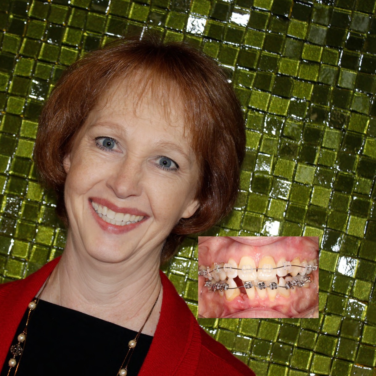 Salem Braces