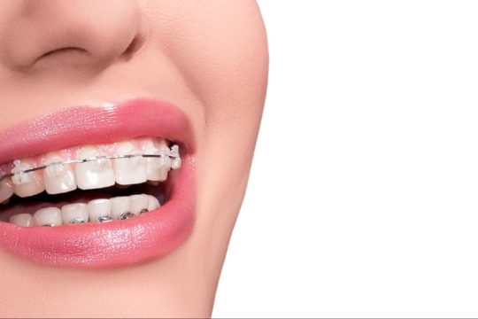 How to Care For Your Teeth After Braces