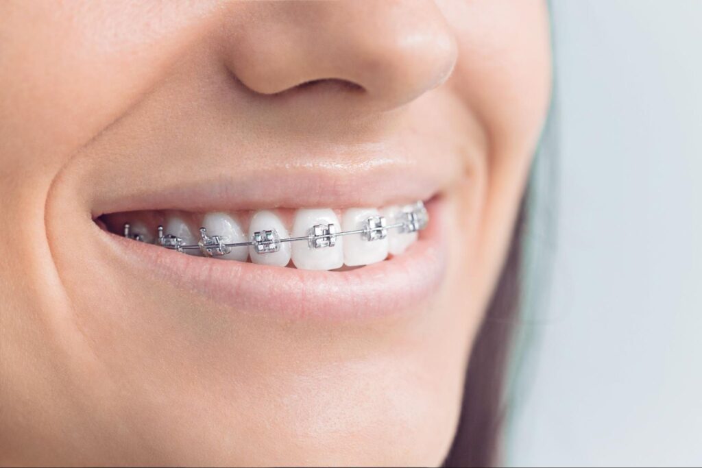 7 Braces Myths You Need to Know