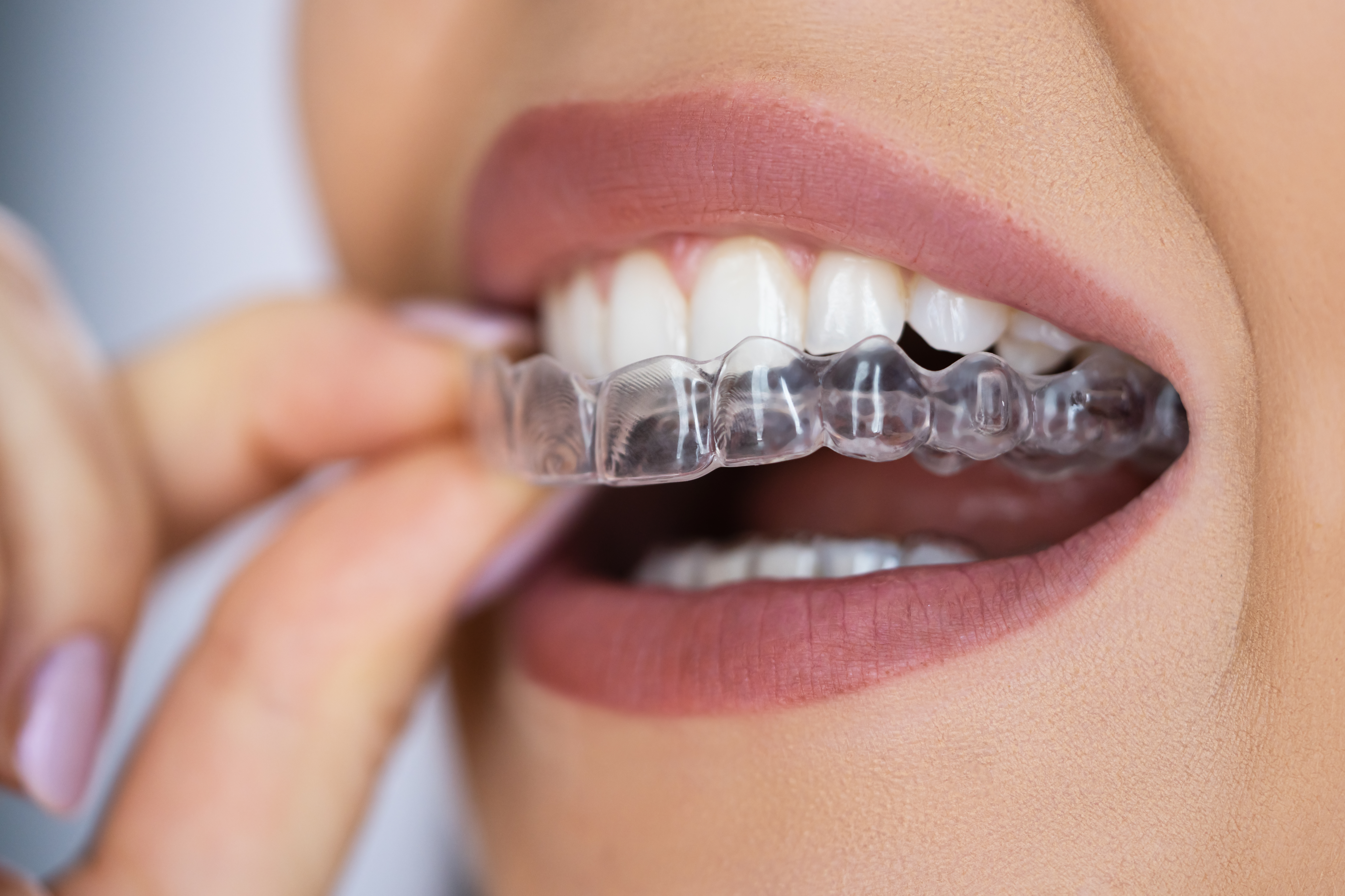 Back to School With Invisalign