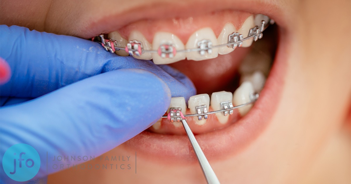Dr working on braces salem