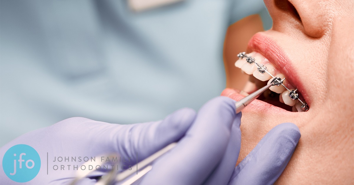 Woman getting rubber bands on for braces salem