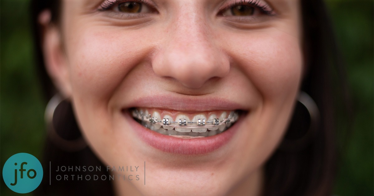 Do Braces Hurt?