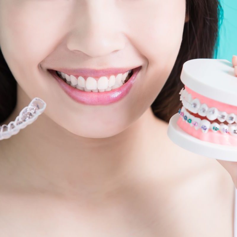 The Different Types of Braces